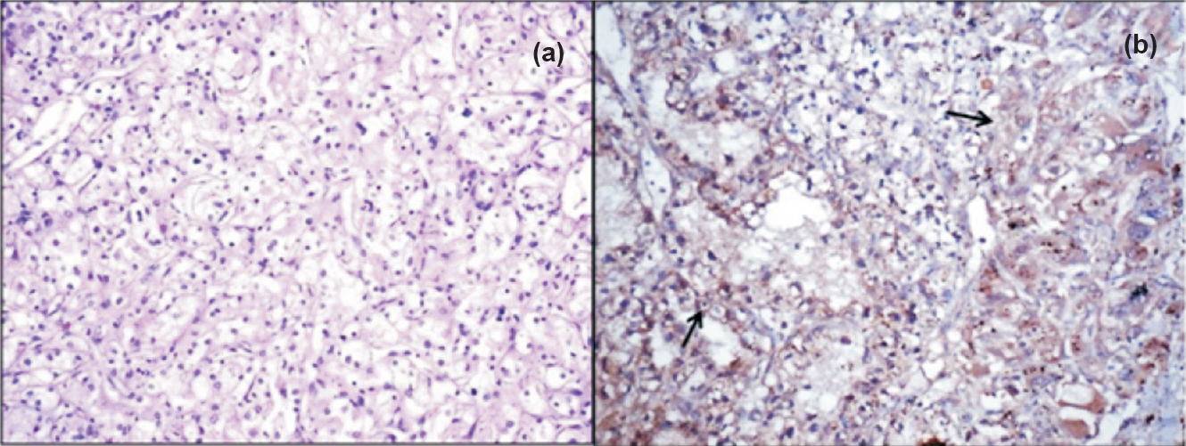 (a). A case of clear cell renal cell carcinoma in a 12 year old child (H&Ex200). (b) Immuostaining shows cytoplasmic WT1 expression in the tumour tissue (arrows) (Immunostain x200).
